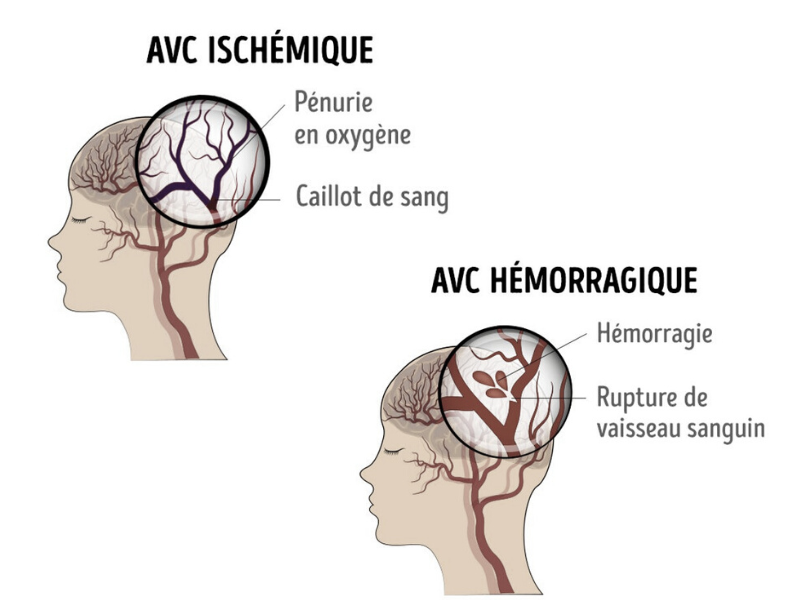 FRANCE AVC - Association d'aide aux victimes d'Accident Vasculaire ...